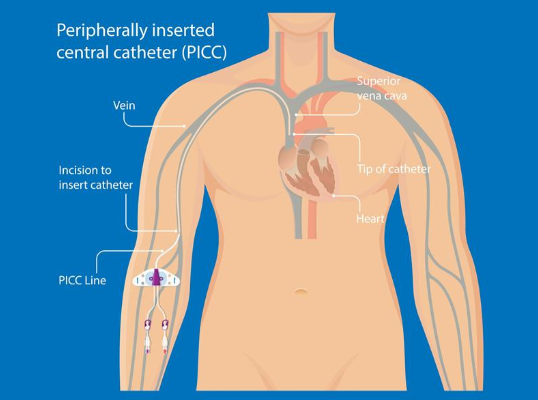 Getting Discharged With a PICC | Gillette | Gillette Children's