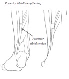 Anterior/Posterior Tibialis Lengthening/Transfer/ Split Transfer ...