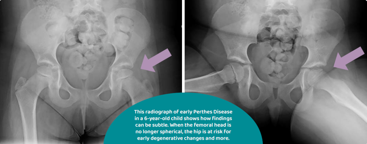 /assets/Perthes_Quick_Guide.png