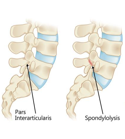 A diagram of the spine showing where a spondylolysis occurs.