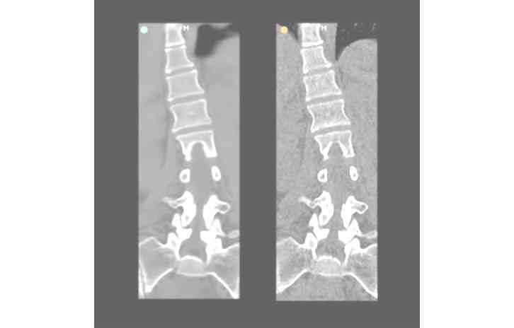 An MRI image of a spine with scoliosis curvature.